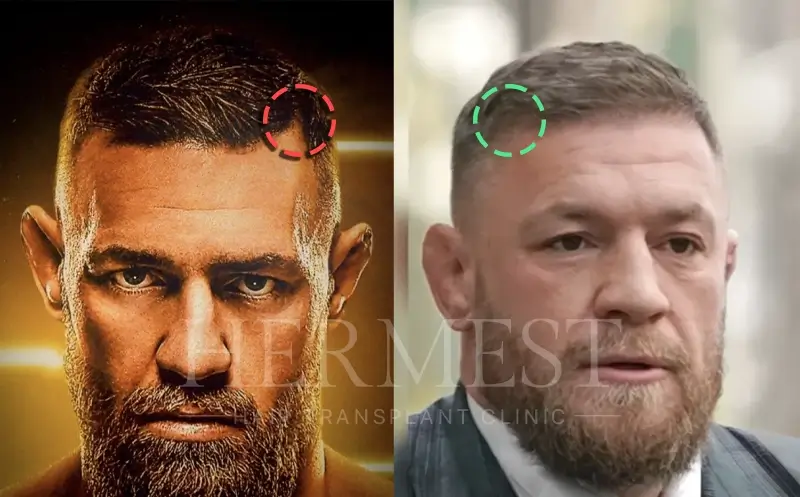 Conor McGregor Hair Transplant