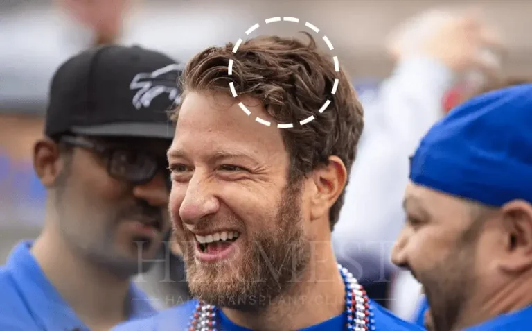 Dave Portnoy Hair Transplant