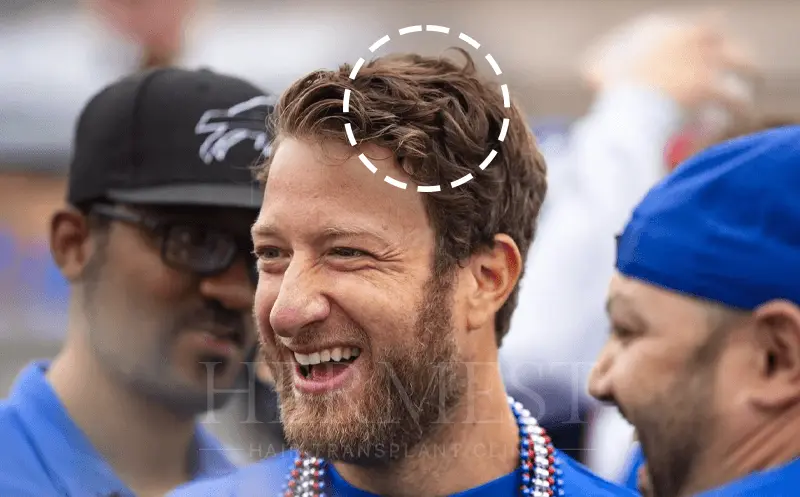Dave Portnoy Hair Transplant