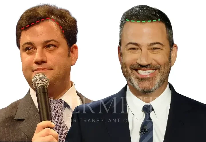 Jimmy Kimmel Hair Transplant: Truth, Hairline Analysis & Facts 6 Jimmy Kimmel Hair Transplant