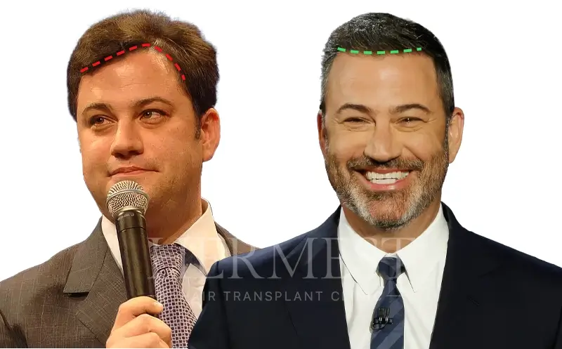 Jimmy Kimmel Hair Transplant