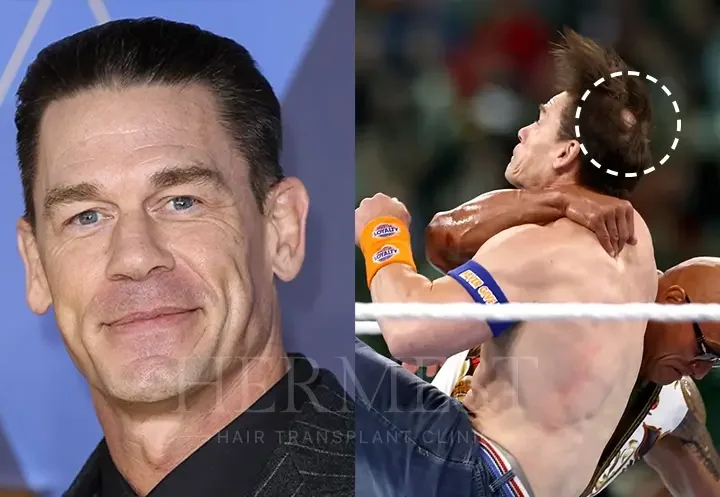 John Cena Hair Transplant: Crown Restoration, Grafts, & Results 10 John Cena Hair Transplant