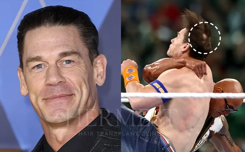 John Cena Hair Transplant