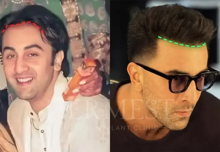 Ranbir Kapoor Hair Transplant: Before & After, Truth, Grafts Explained 4 Ranbir Kapoor Hair Transplant