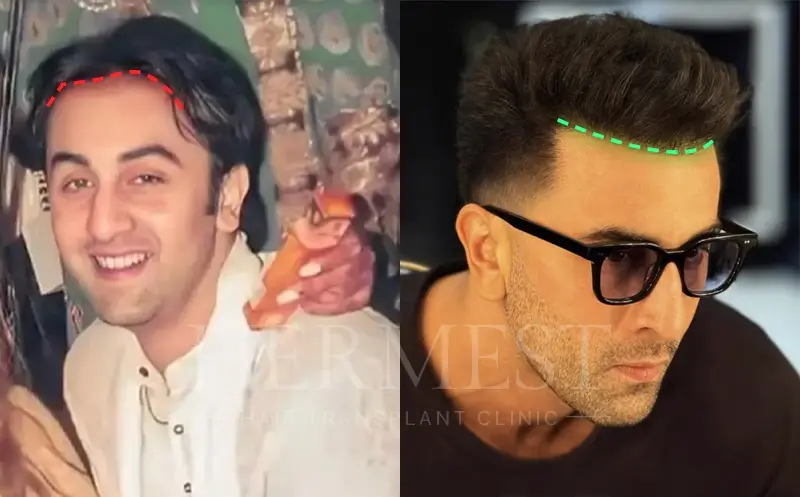 Ranbir Kapoor Hair Transplant