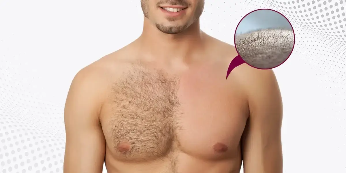 What is a body hair transplant (BHT)