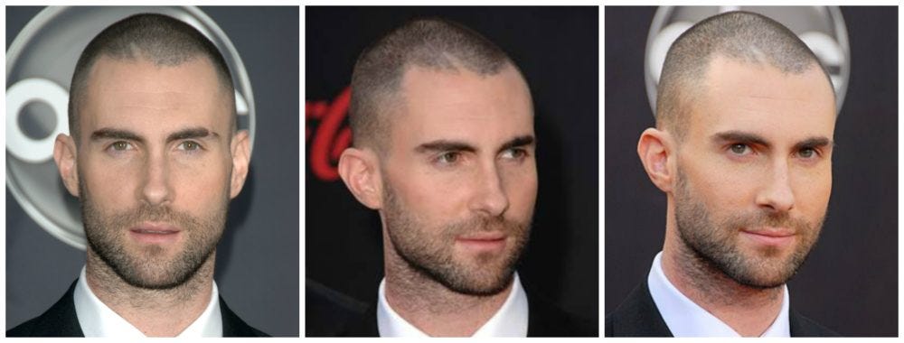 Adam Levine Hair Transplant: Truth & Hairline Analysis 4 If he had a transplant, what technique was likely used?