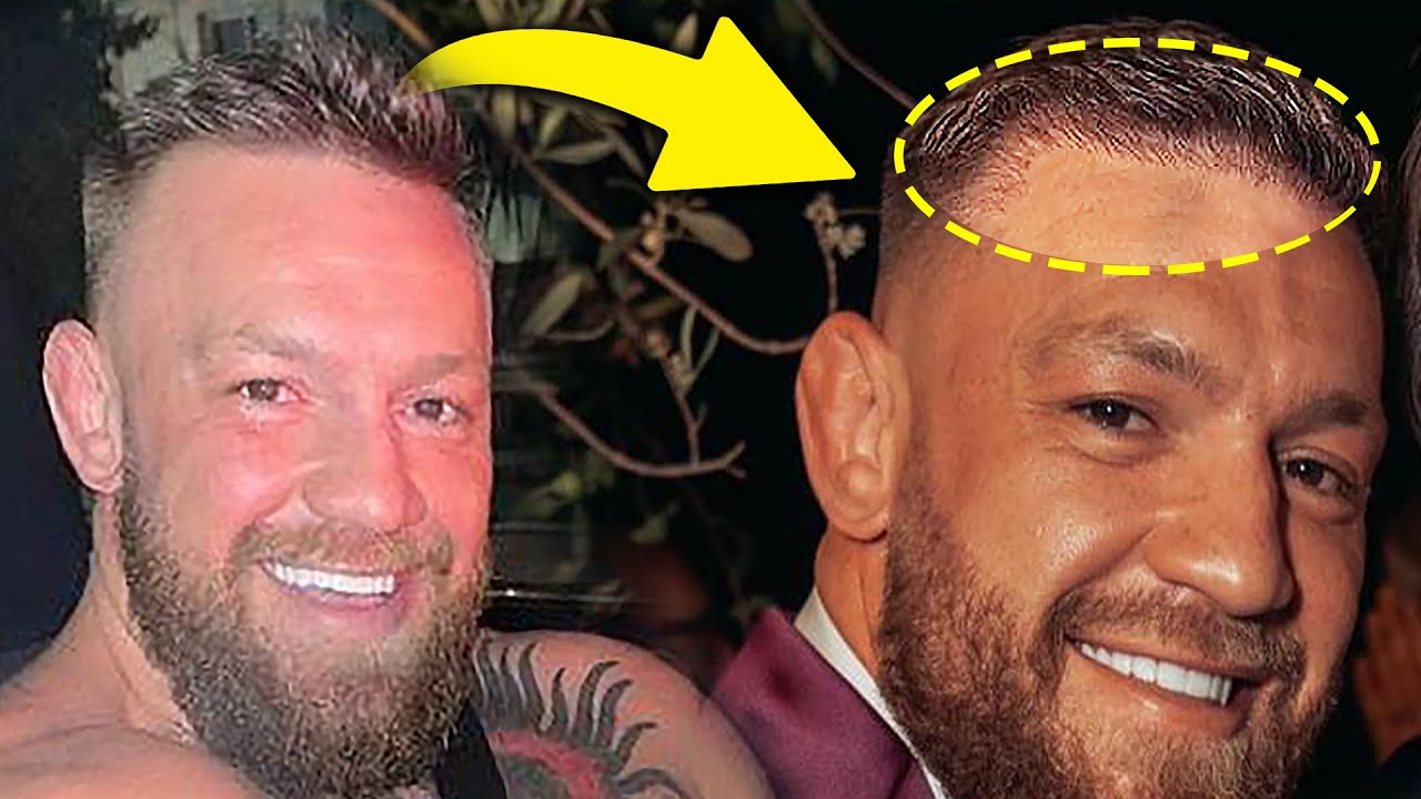 Conor McGregor Hair Transplant: Before & After, Truth & Results 4 Conor McGregor hairline before and after analysis