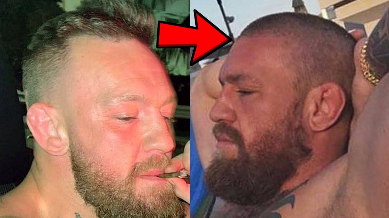 Conor McGregor Hair Transplant: Before & After, Truth & Results 3 Did Conor McGregor get a hair transplant?