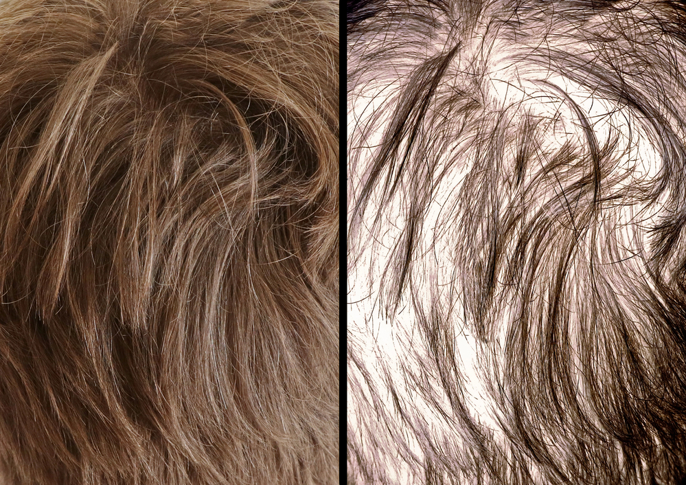MSM for Hair Growth: Benefits, Dosage, and Side Effects 3 hair growth analysis