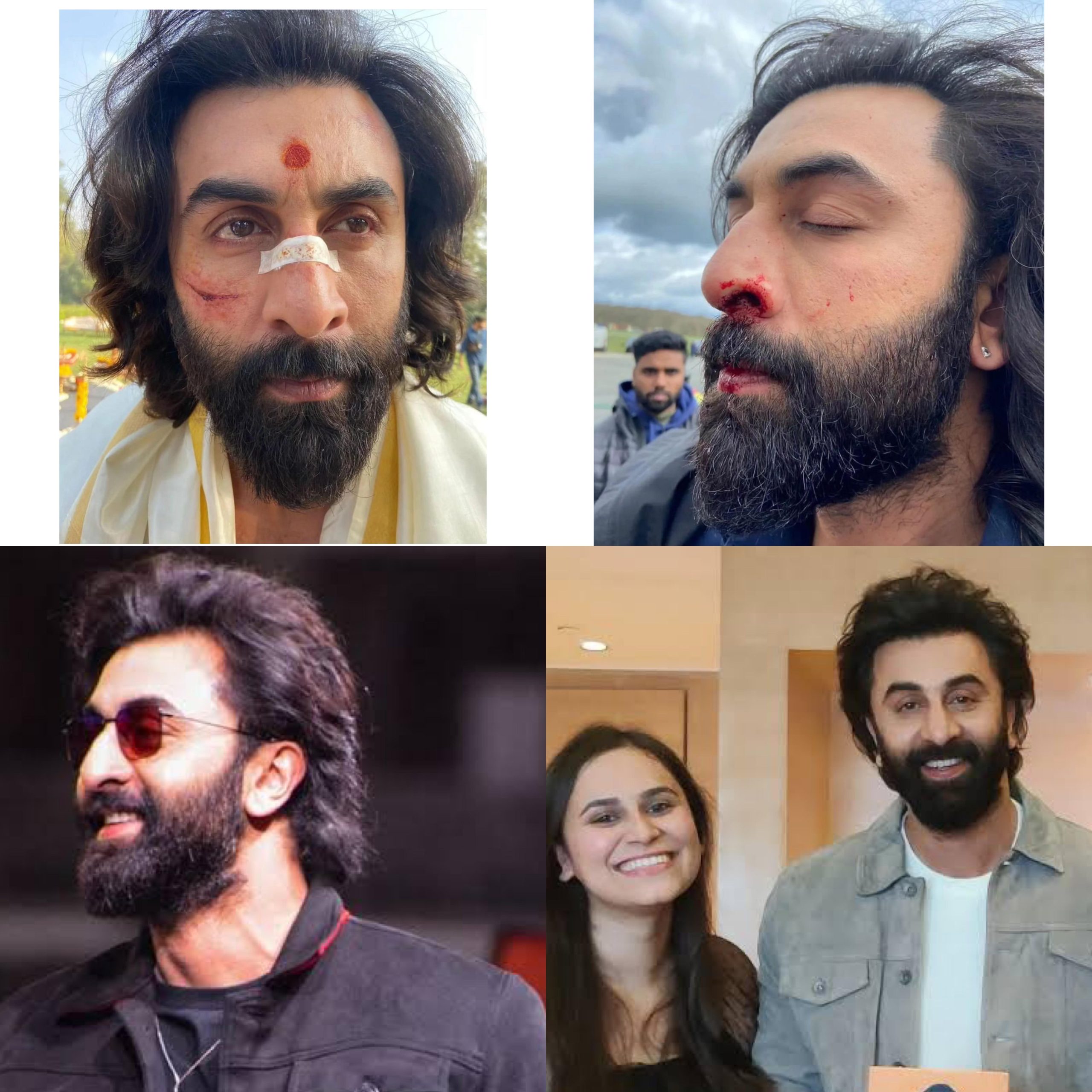 Ranbir Kapoor Hair Transplant: Before & After, Truth, Grafts Explained 2 ranbir kapoor hair transplant before after