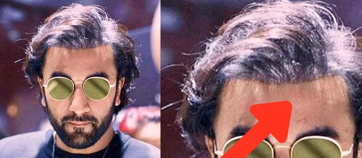 Ranbir Kapoor Hair Transplant: Before & After, Truth, Grafts Explained 3 ranbir kapoor hair transplant