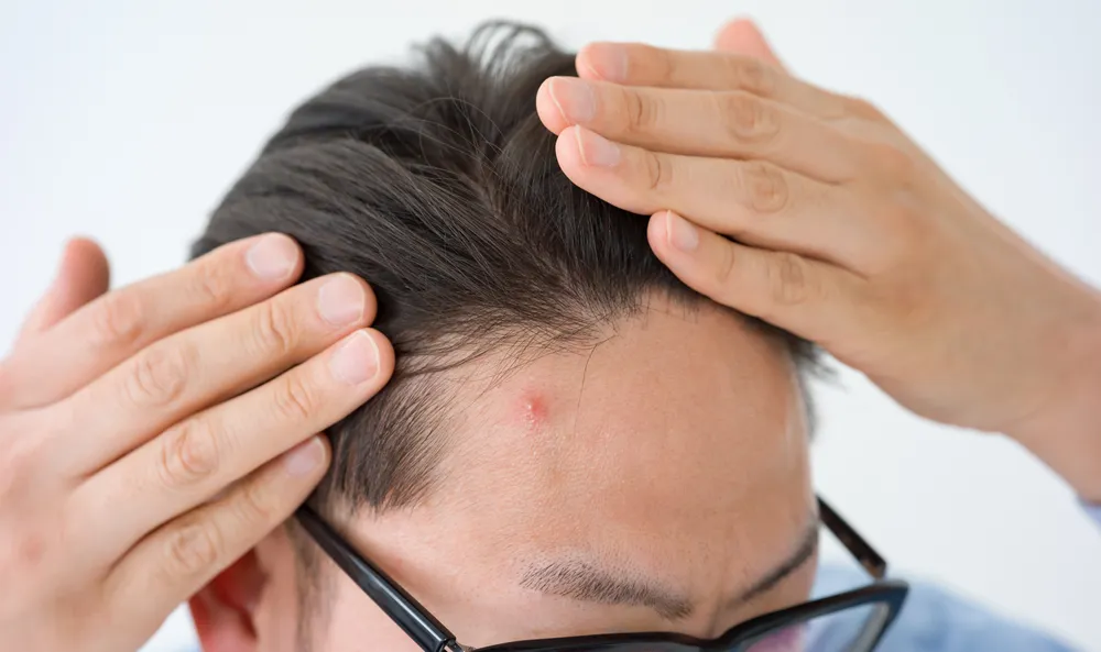 Scalp Health: How to Combat Pimples and Maintain Clear Skin 3 scalp acne