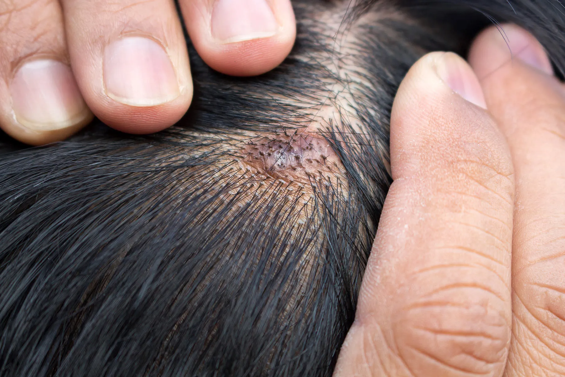 Scalp Health: How to Combat Pimples and Maintain Clear Skin 2 scalp pimples
