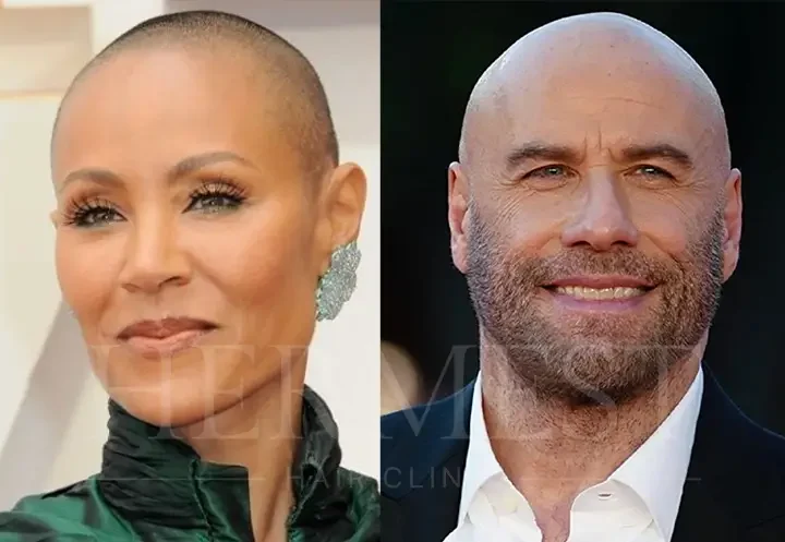 Celebrities with Alopecia