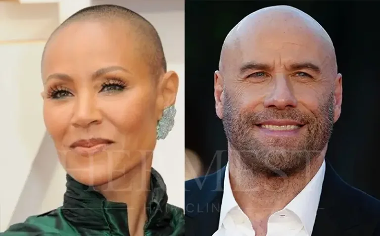 Celebrities with Alopecia