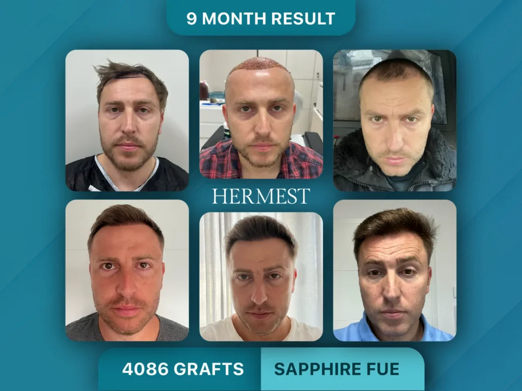 Trapianto di capelli prima e dopo, Sapphire FUE – 4086 innesti