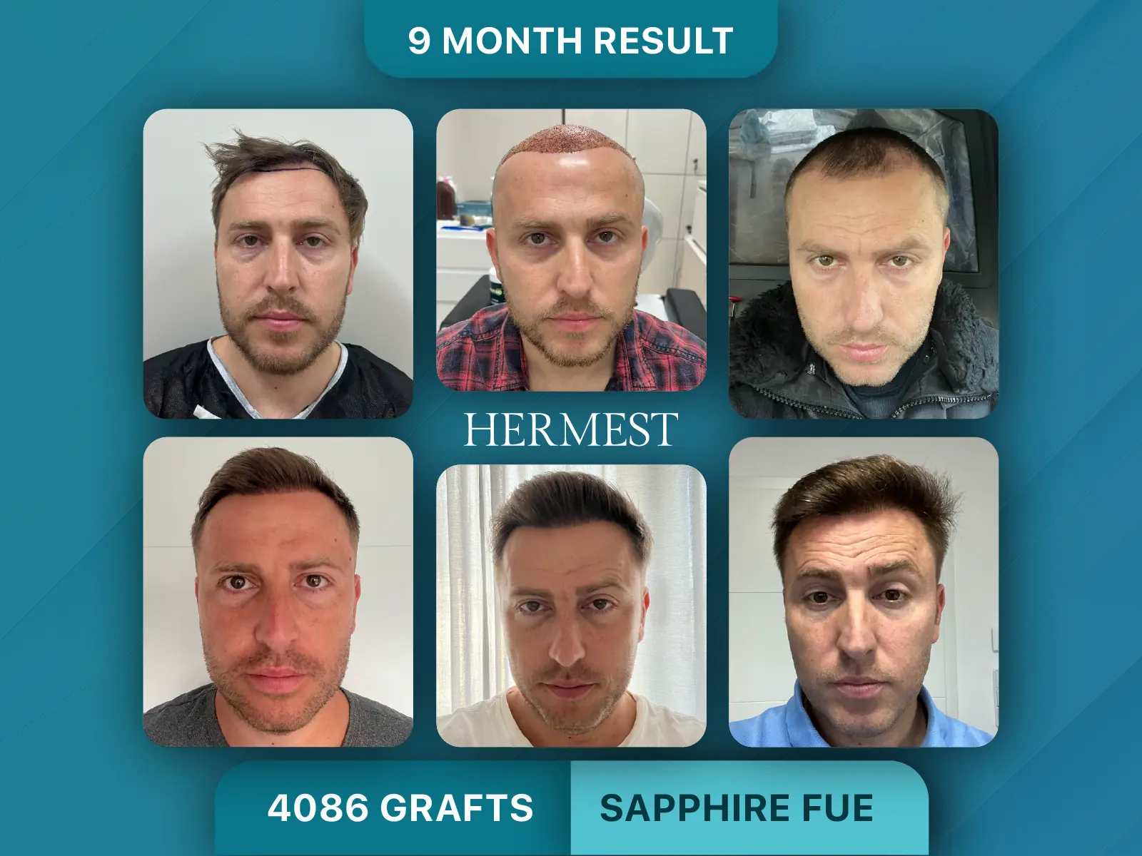 Hair Transplant Before After 4086 Grafts