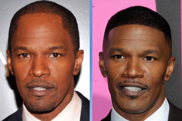 Jamie Foxx Hair Transplant: Hairline Analysis & Results Explained 7 Why his results look natural