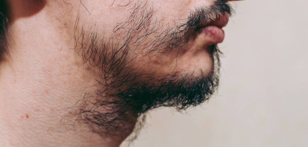 Patchy Beard Growth: Causes, Fixes, Minoxidil & Transplant Guide 2 Why is my beard patchy?