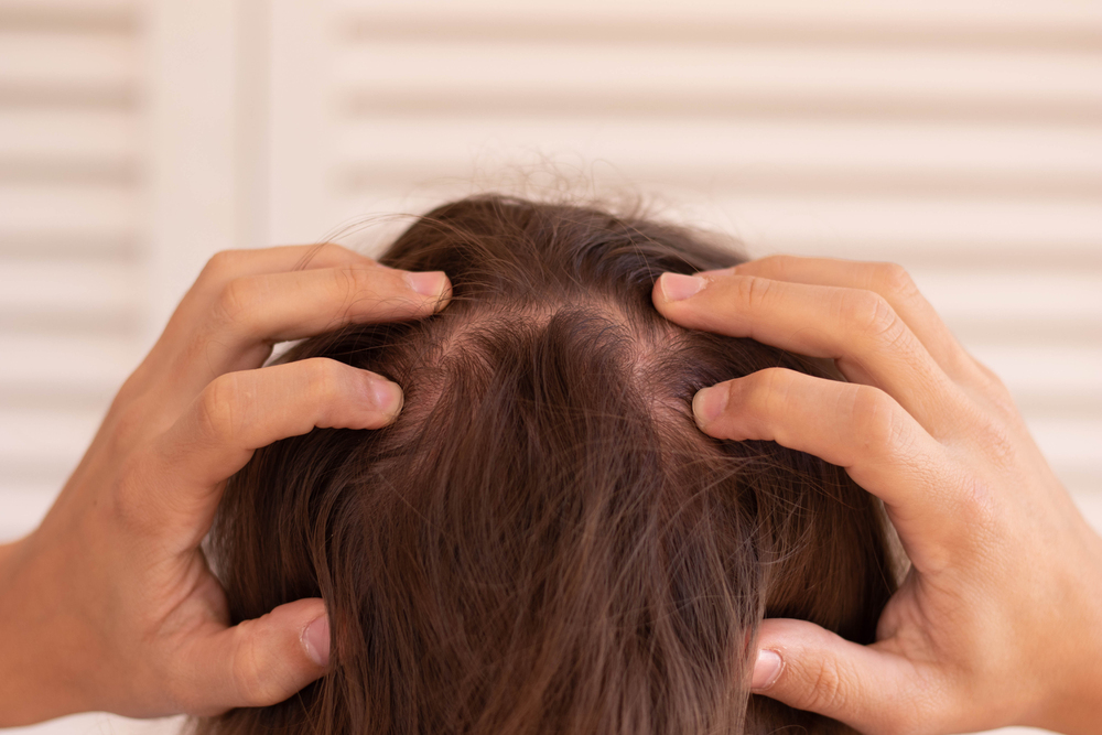 How to Stop Hair Loss From Antidepressants: Causes, Tests & Recovery 5 Is SSRI Hair Loss Reversible?