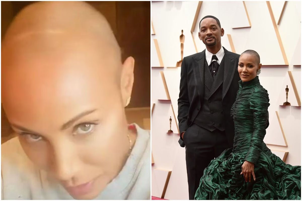 Top Celebrities with Alopecia: Real Cases, Types & Treatment 2 celebrities with alopecia
