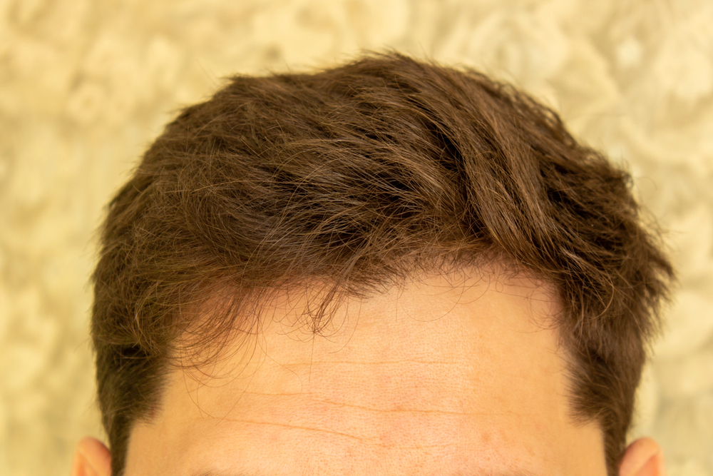 Types of Hairlines: Shapes, Stages & What They Mean (Male Guide) 2 choosing the right hairline
