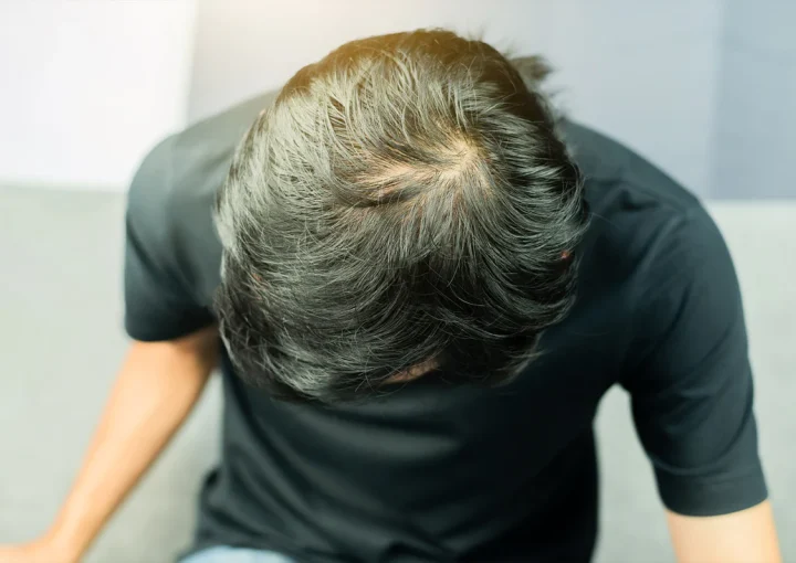 Cowlick: Is It A Sign of Balding? How to Tell the Difference at the Crown 10 cowlicks review