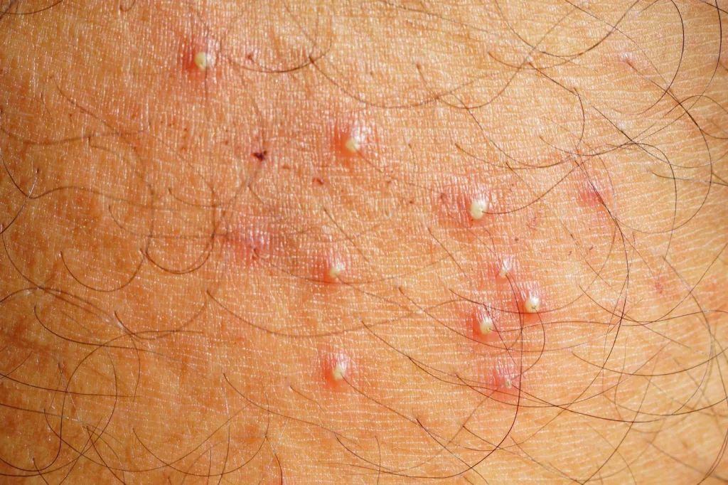Close-up of folliculitis: small red, pus-filled bumps around hair follicles on the skin