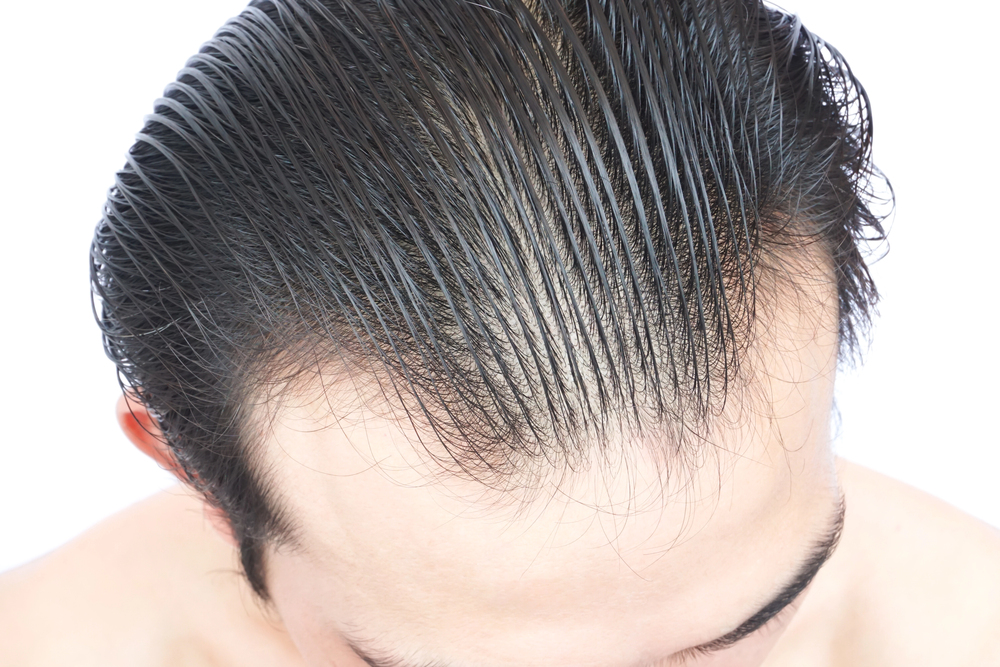 Types of Hairlines: Shapes, Stages & What They Mean (Male Guide) 7 Receding Hairline