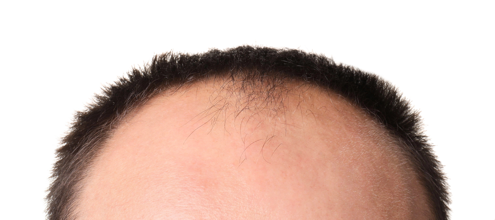 Types of Hairlines: Shapes, Stages & What They Mean (Male Guide) 4 Rounded Hairline