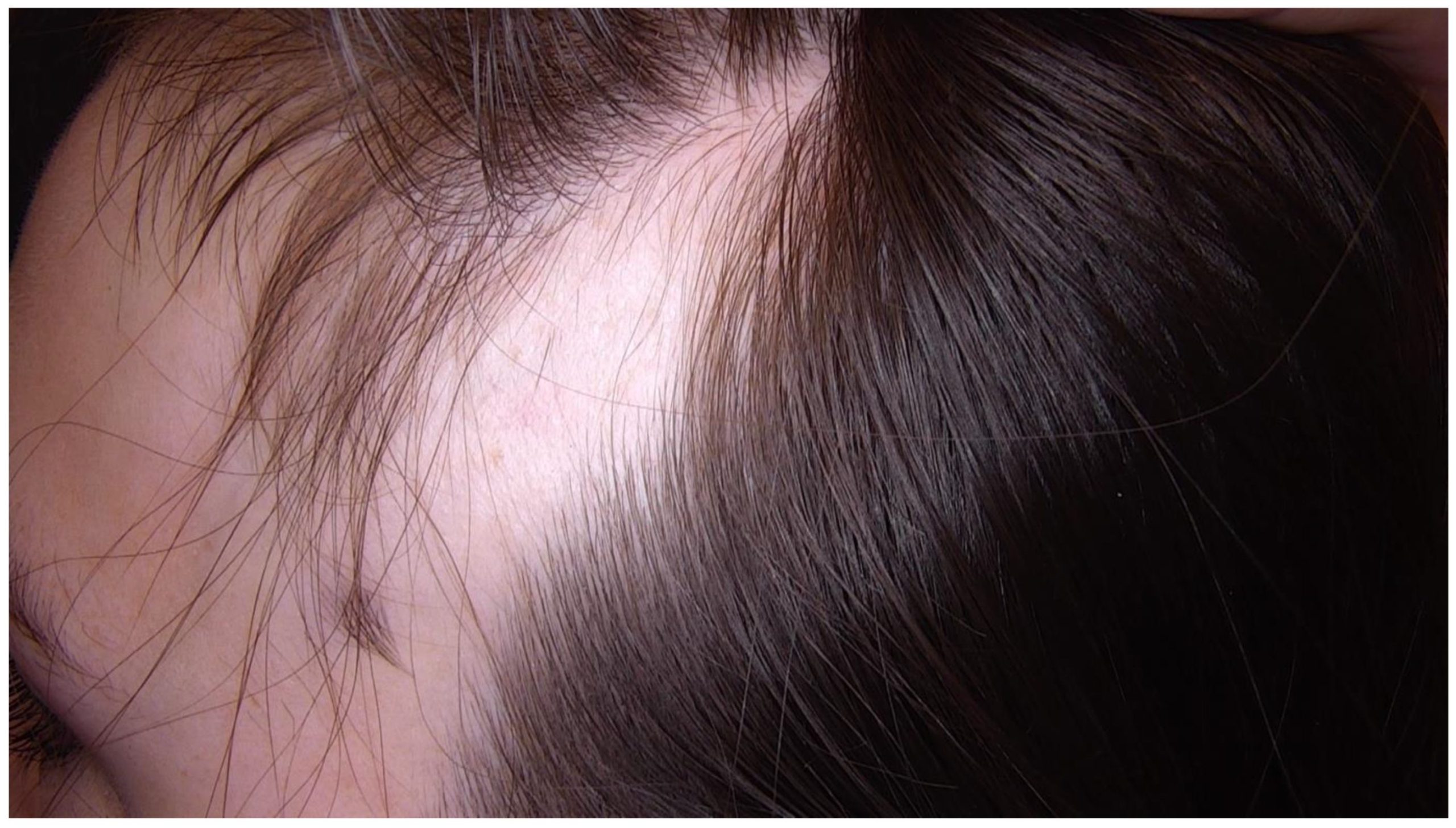 Triangular Alopecia: Causes, Treatment, and Does It Spread? 2 What Is Triangular Alopecia?