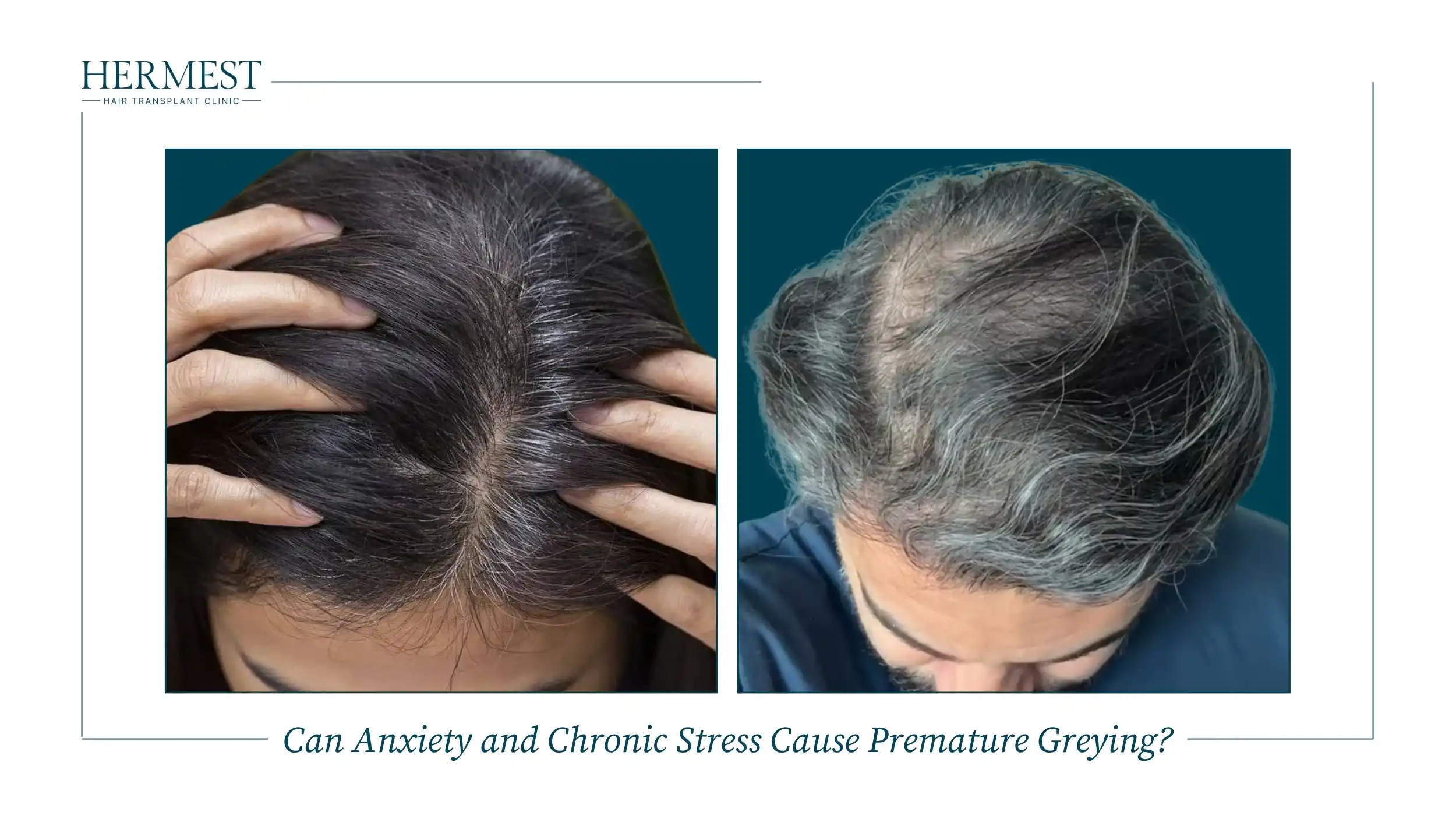 Can Anxiety and Chronic Stress Cause Premature Greying