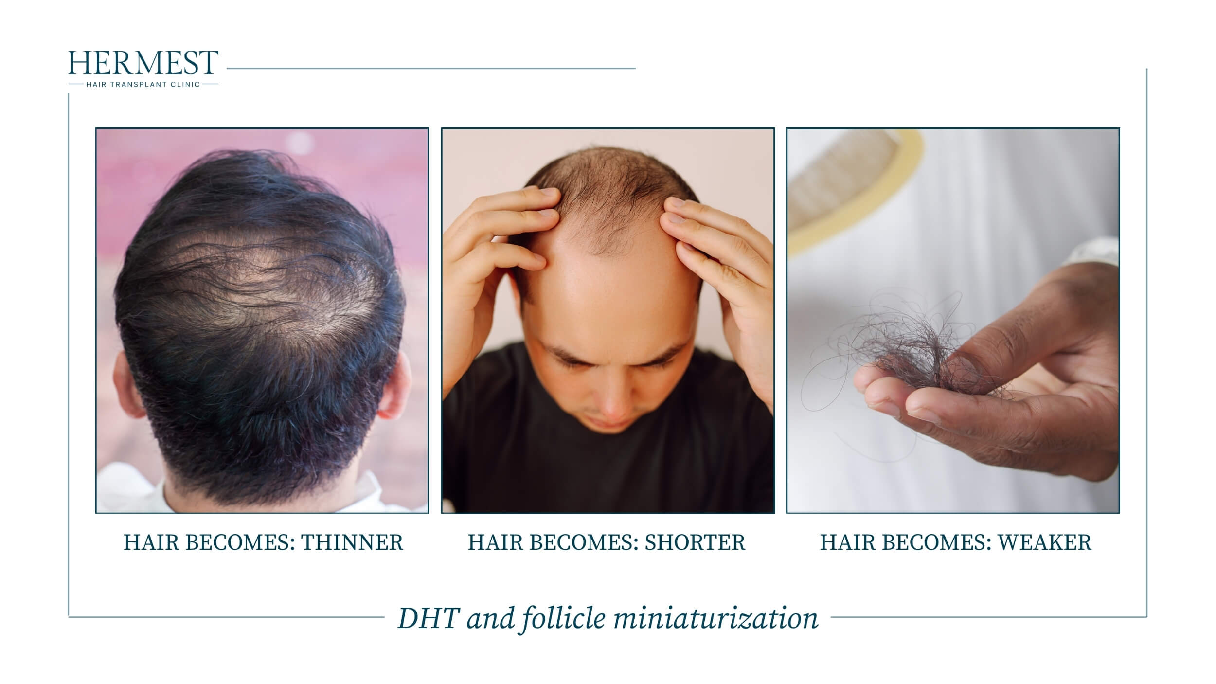 DHT and follicle miniaturization