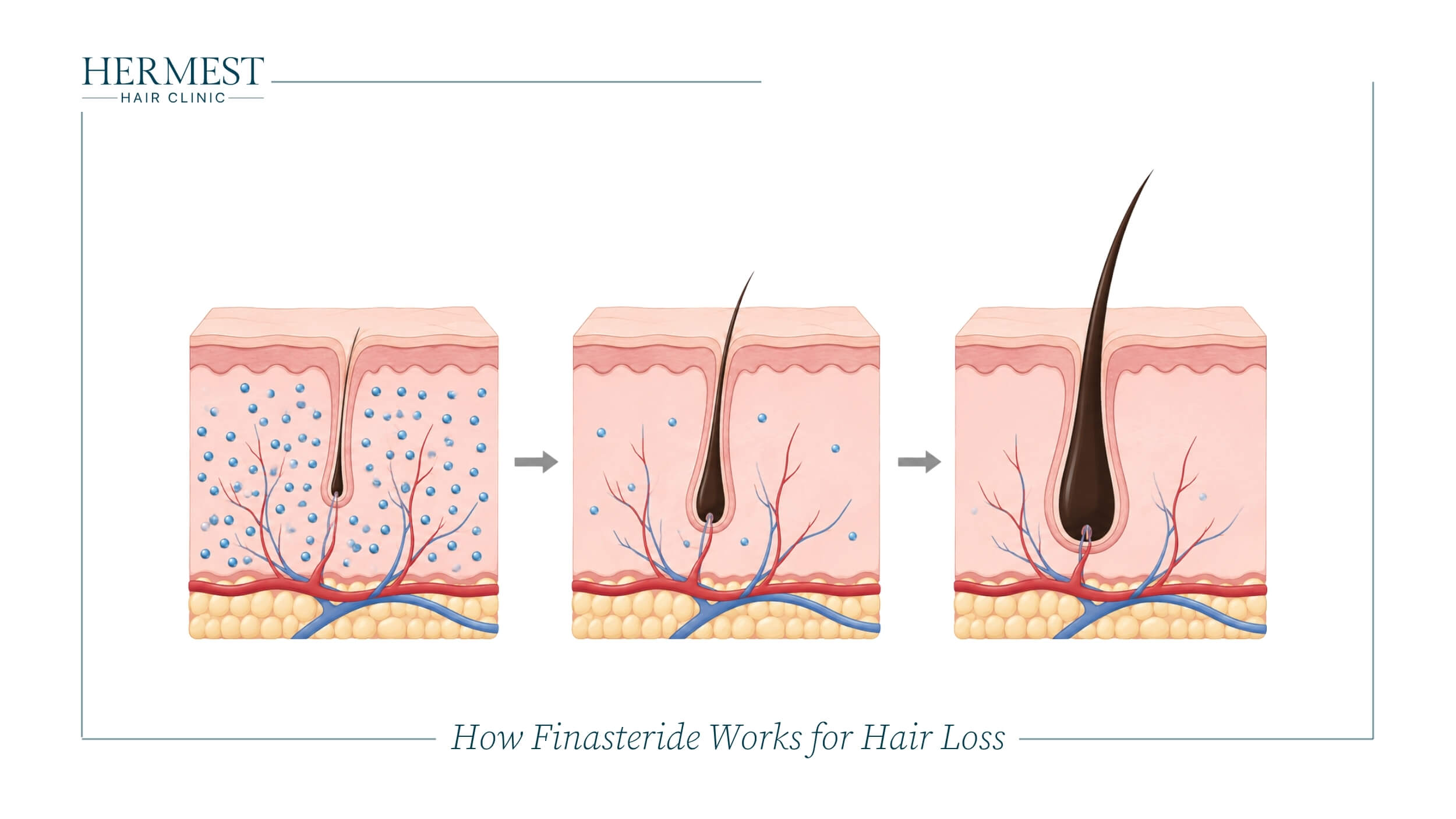 How Finasteride Works for Hair Loss