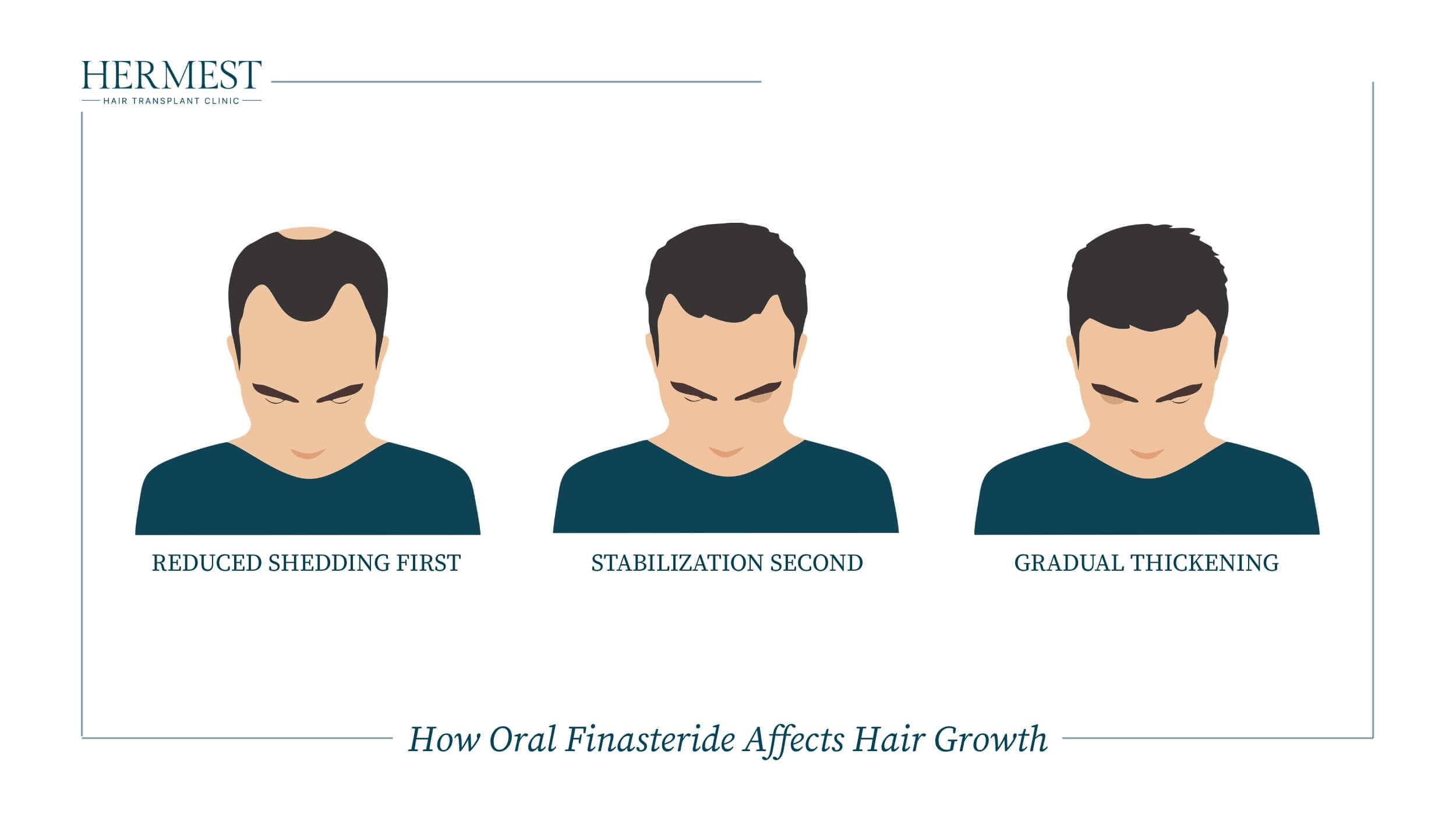 How oral finasteride affects hair growth