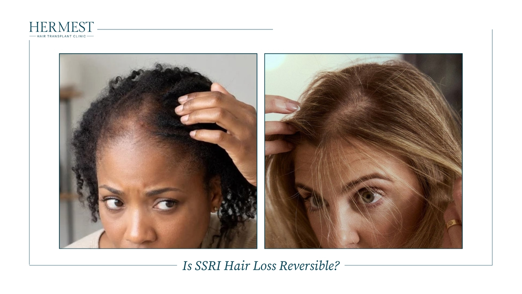Is SSRI Hair Loss Reversible