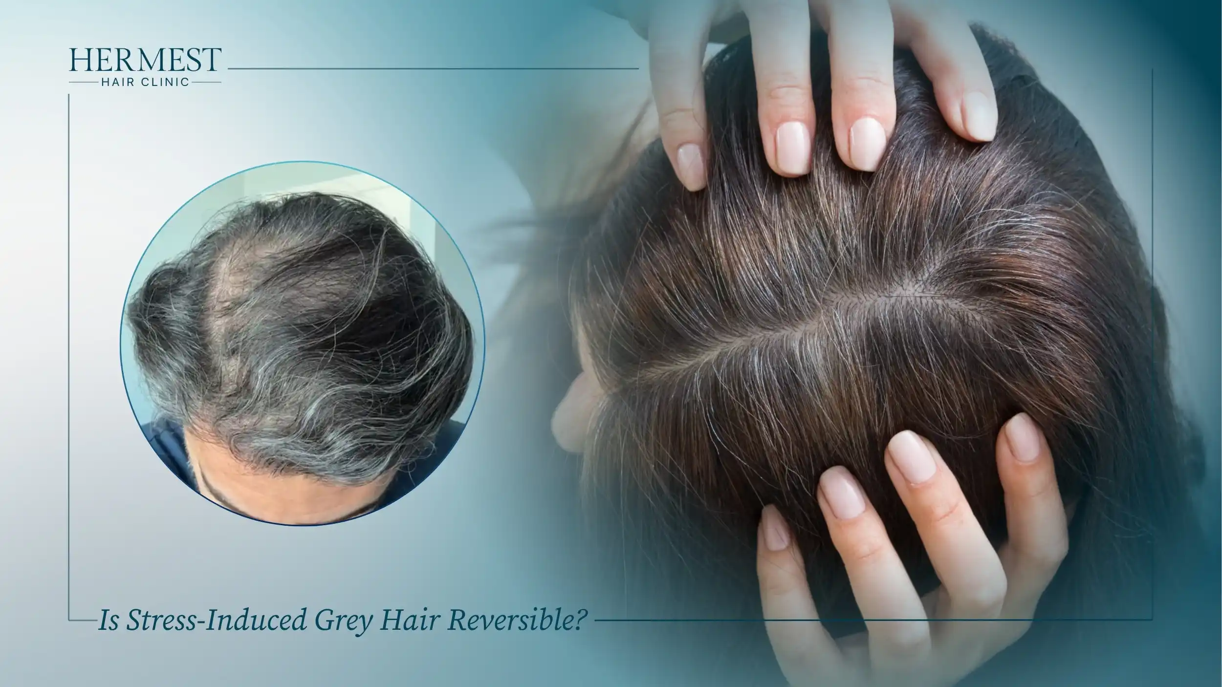 Is Stress-Induced Grey Hair Reversible