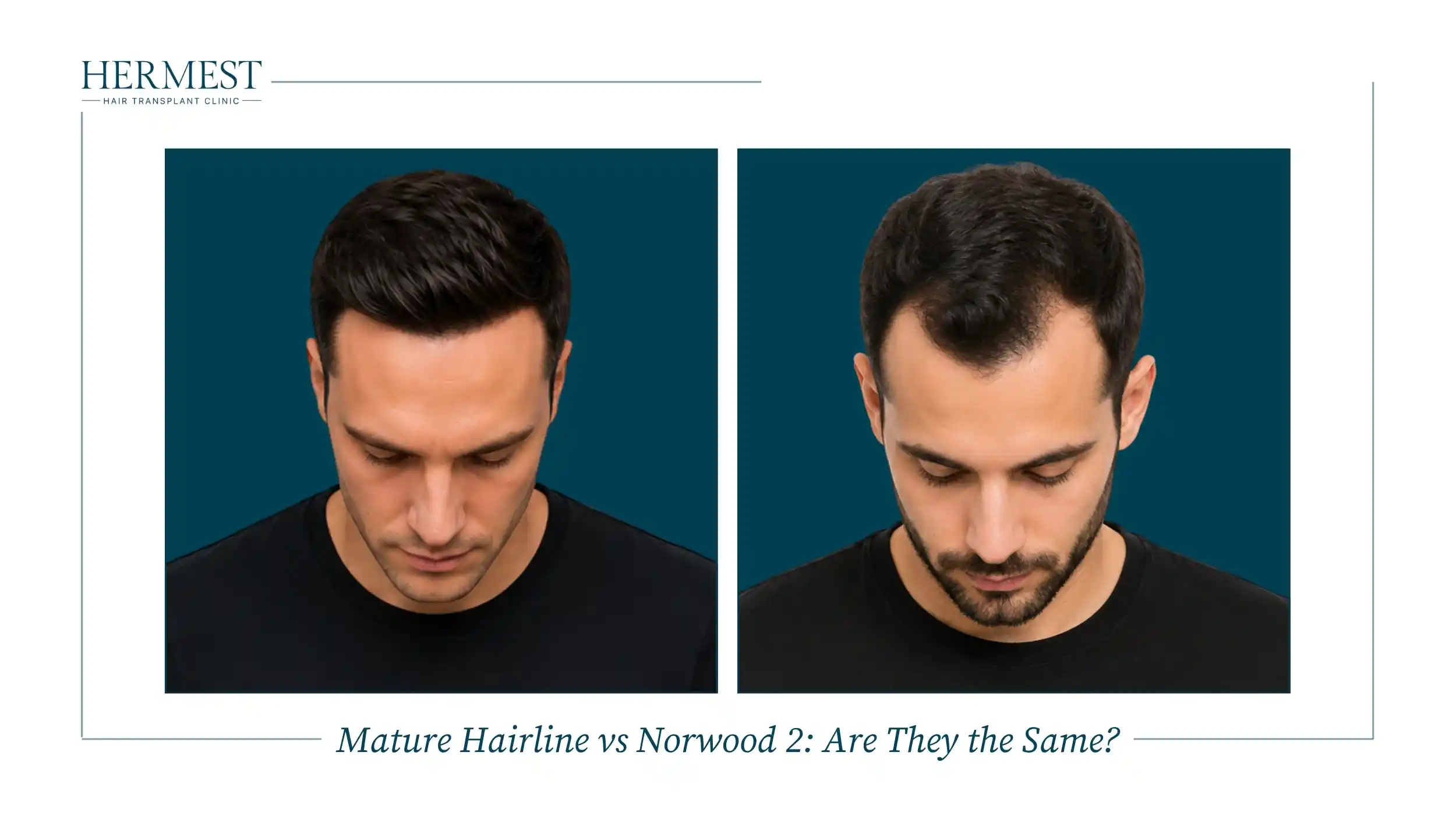Comparison of a mature hairline and a Norwood 2 hairline with mild temple recession on two men