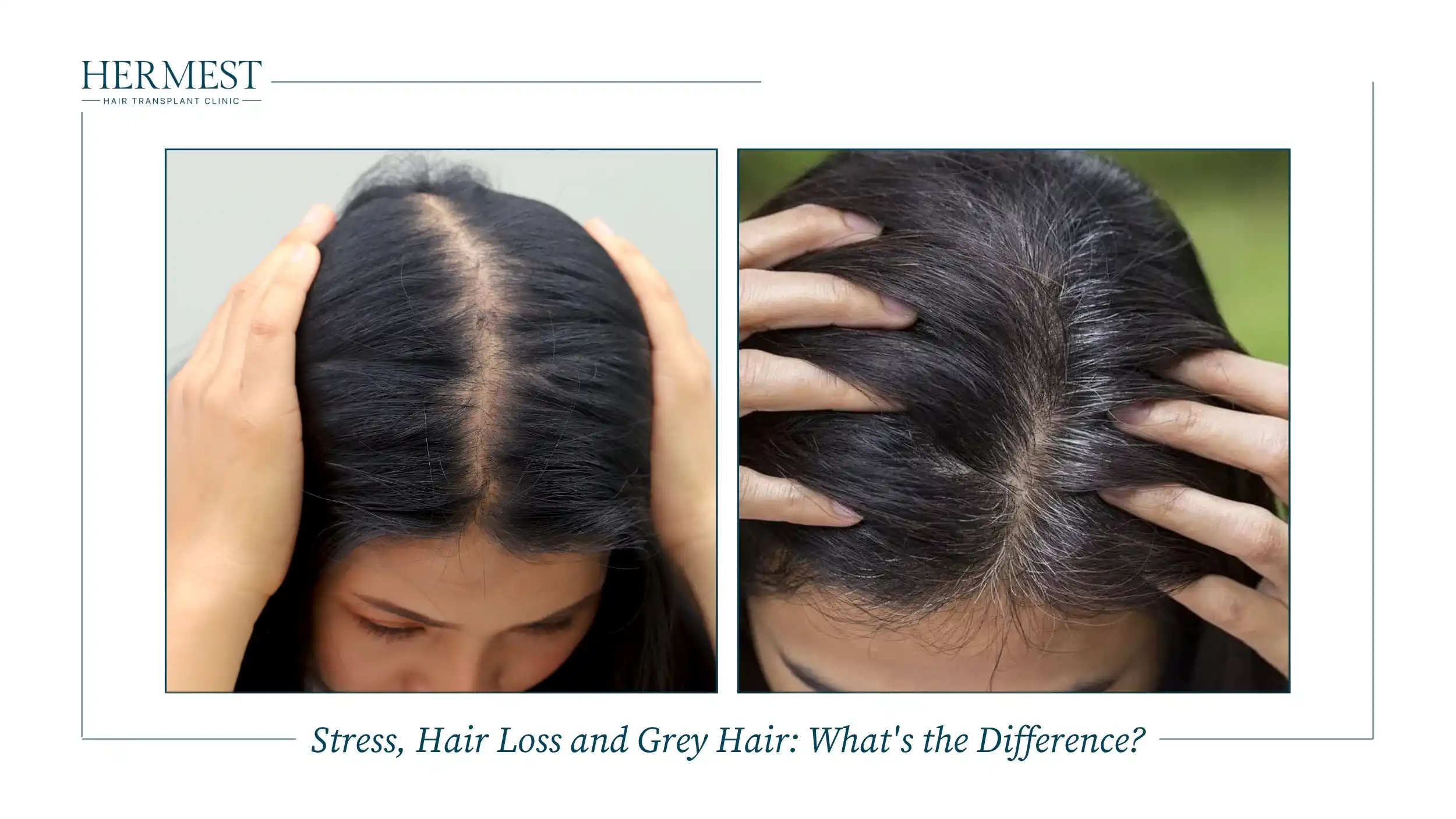 Stress, Hair Loss and Grey Hair What's the Difference
