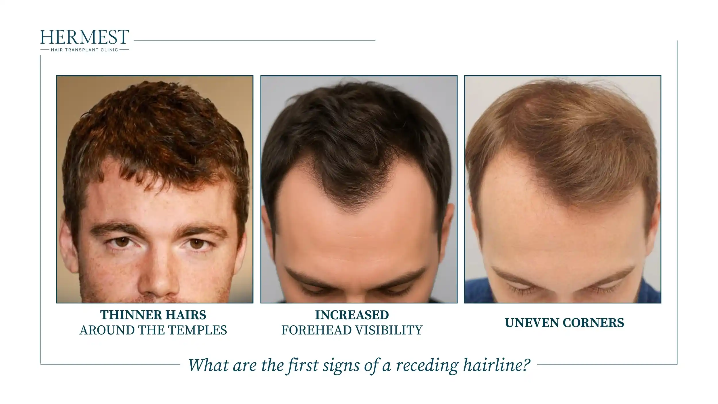 First signs of a receding hairline: thinner hair at the temples, more visible forehead and uneven corners