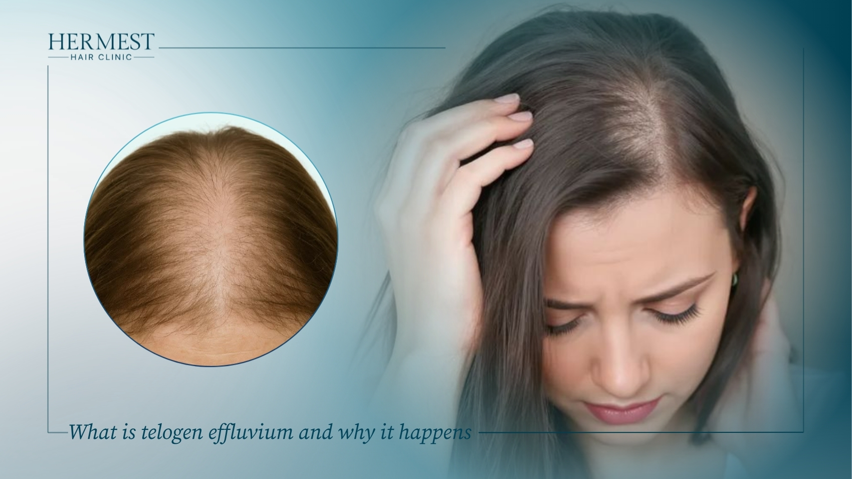What is telogen effluvium and why it happens