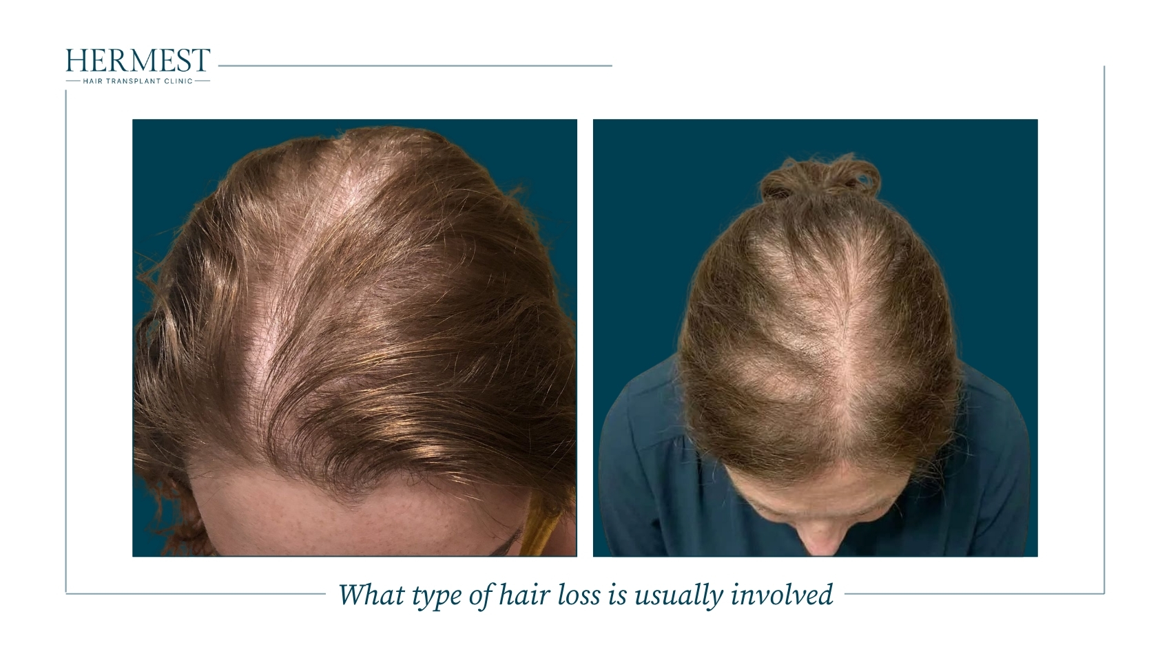 What type of hair loss is usually involved