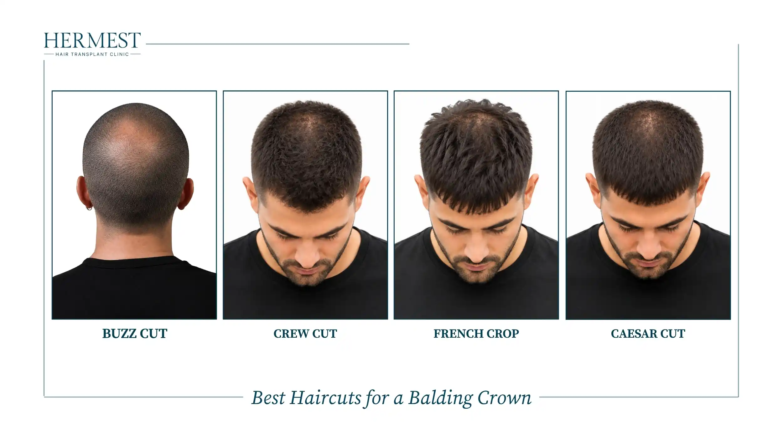 Best Haircuts for a Balding Crown