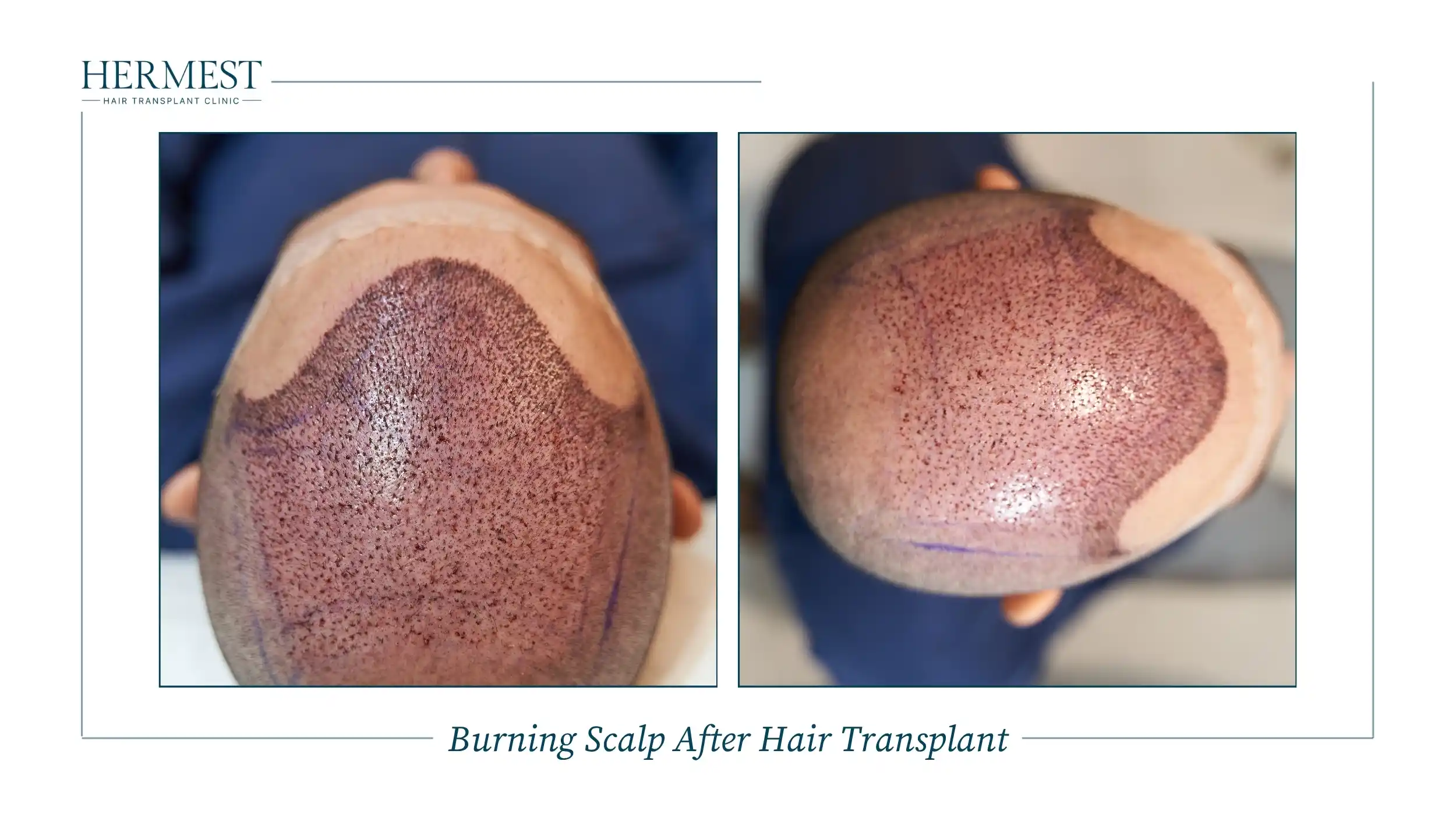 Burning Scalp After Hair Transplant