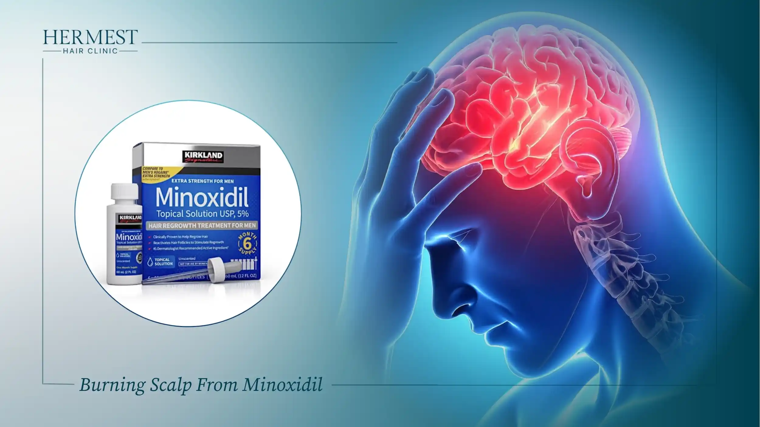 Burning Scalp From Minoxidil