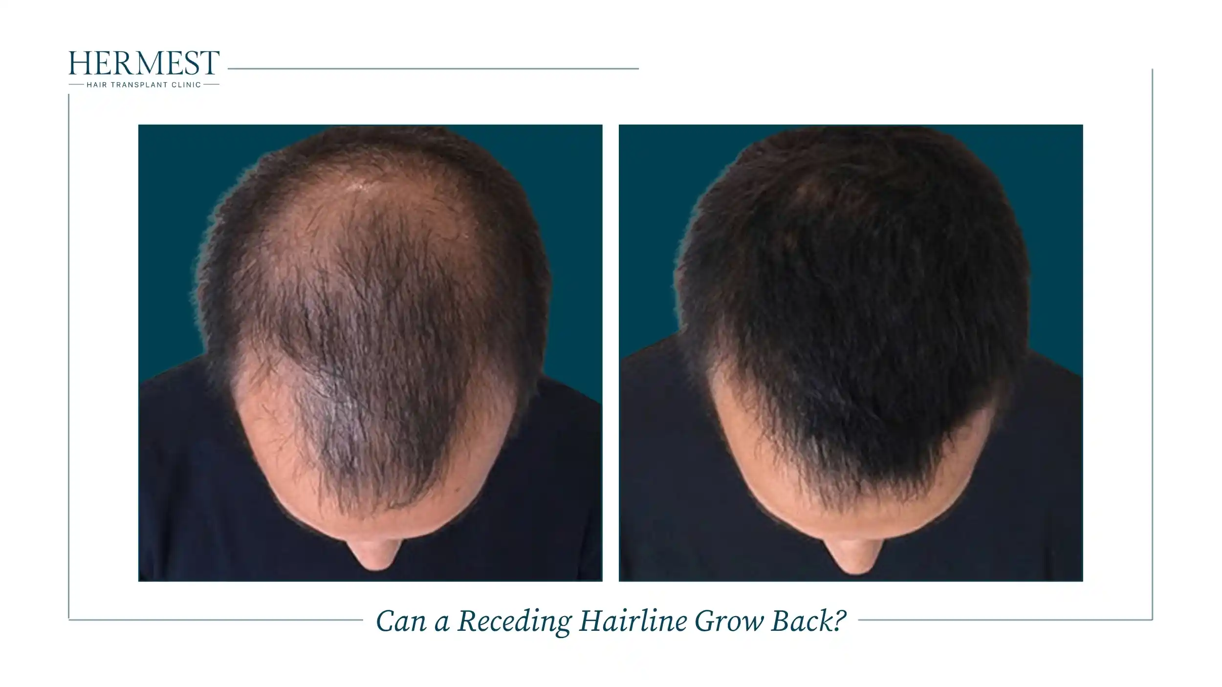Can a Receding Hairline Grow Back