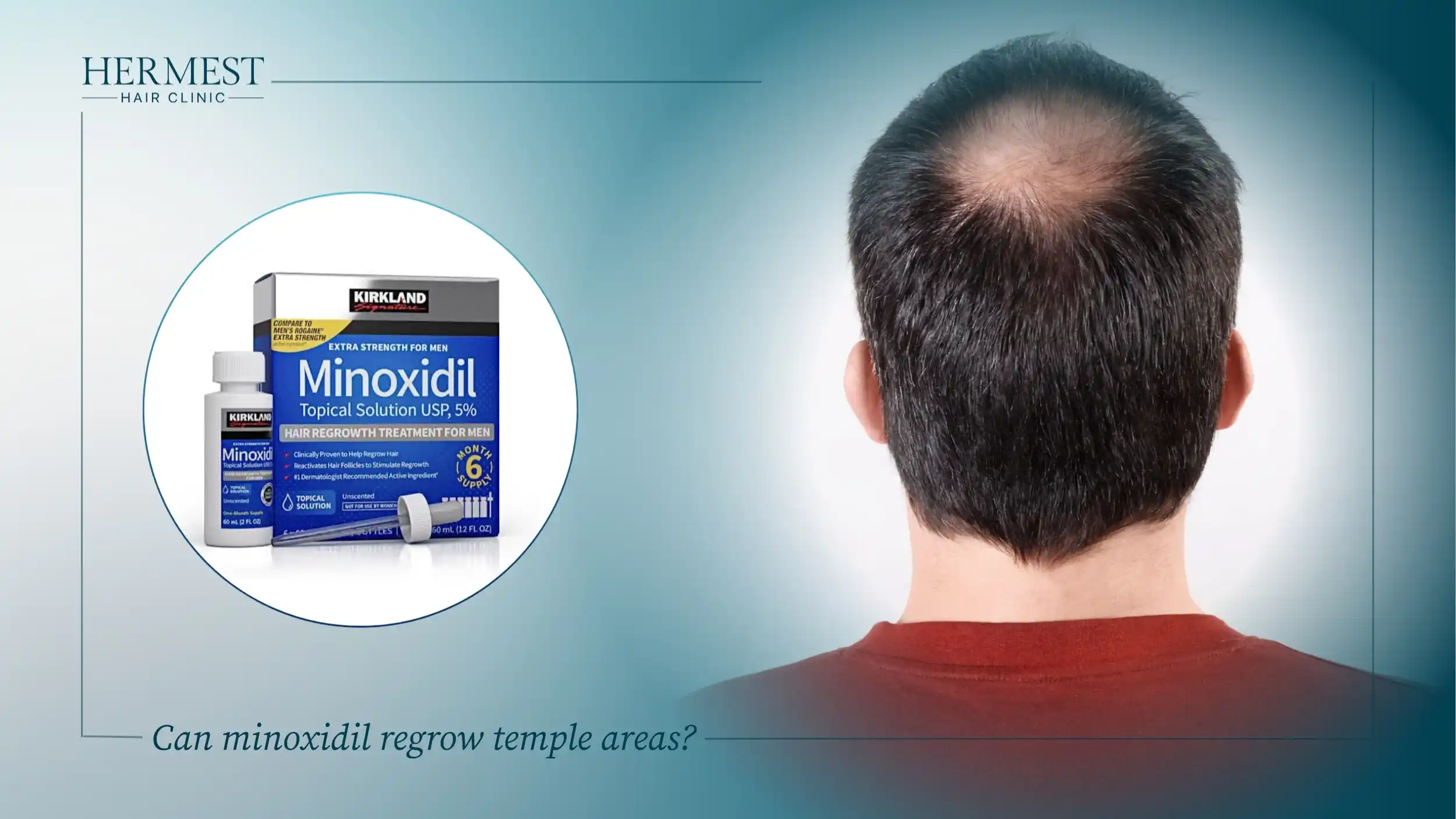5% minoxidil box and bottle next to a man with thinning at the crown, asking if minoxidil regrows temples