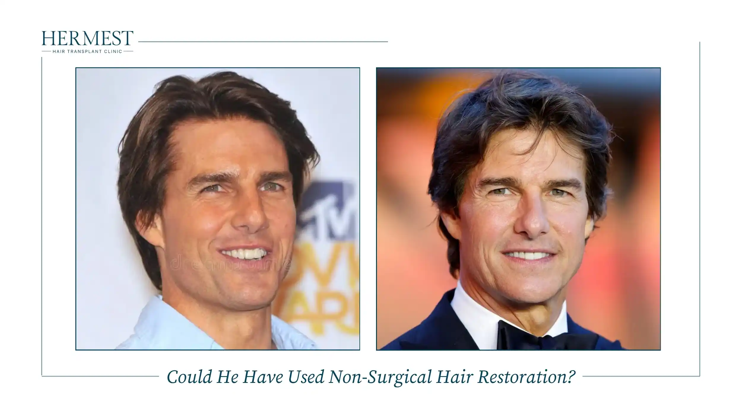 Could He Have Used Non-Surgical Hair Restoration