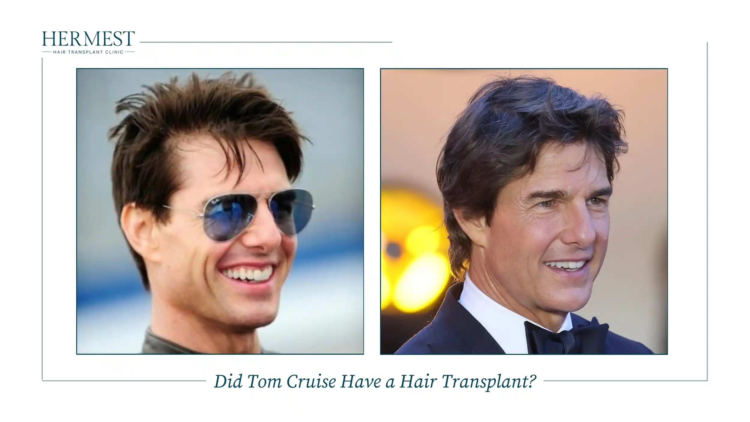 Did Tom Cruise Have a Hair Transplant